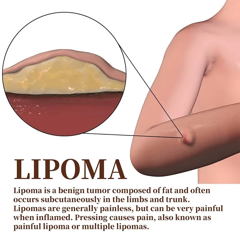 Subcutaneous Lump Removal Soothing Cream Is Suitable for Eliminating Fat Lumps and Reducing Fat Lumps It Is a Body Health Cream