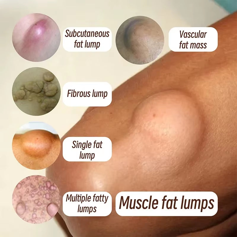 Subcutaneous Lump Removal Soothing Cream Is Suitable for Eliminating Fat Lumps and Reducing Fat Lumps It Is a Body Health Cream