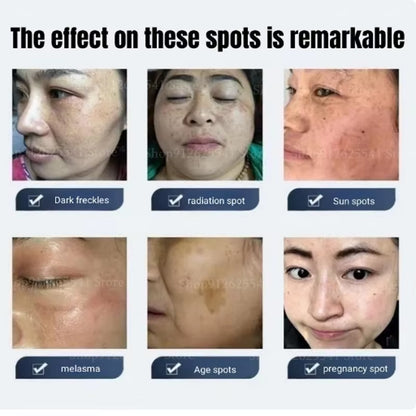 Herbal Astragalus Face Cream Moisturizing Whitening Night Cream Freckle Removal Cream Quick Spot Remover Facial Treatment Gel