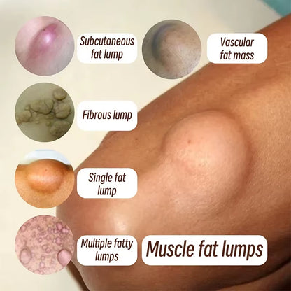 Subcutaneous Lump Removal Soothing Cream Is Suitable for Eliminating Fat Lumps and Reducing Fat Lumps It Is a Body Health Cream